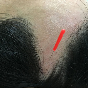 M字型薄毛には鍼灸治療が有効です