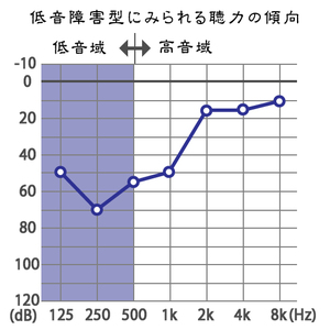 急性低音障害型感音難聴