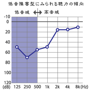 急性低音障害型感音難聴