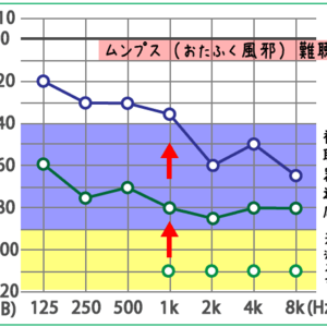 おたふく風邪が原因のムンプス難聴は回復する可能性があります。