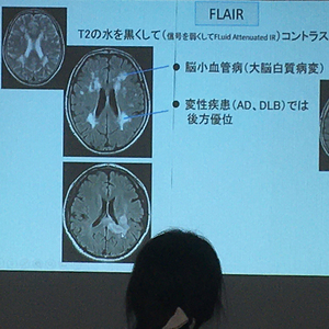 片頭痛をいかにして治すのか