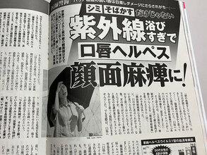 シミ・そばかすだけじゃない！紫外線を浴びることで口唇ヘルペスから顔面神経麻痺を発病