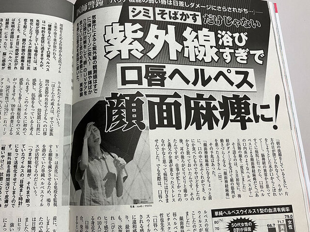 紫外線で顔面神経麻痺