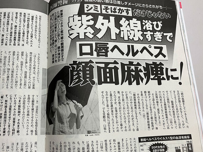 紫外線で顔面神経麻痺